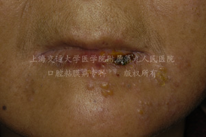 口腔结核复发性唇疱疹萎缩性舌炎游走性舌炎贝氏口疮(bednar ulcer)